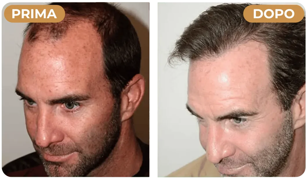 Prima e Dopo HairBoost